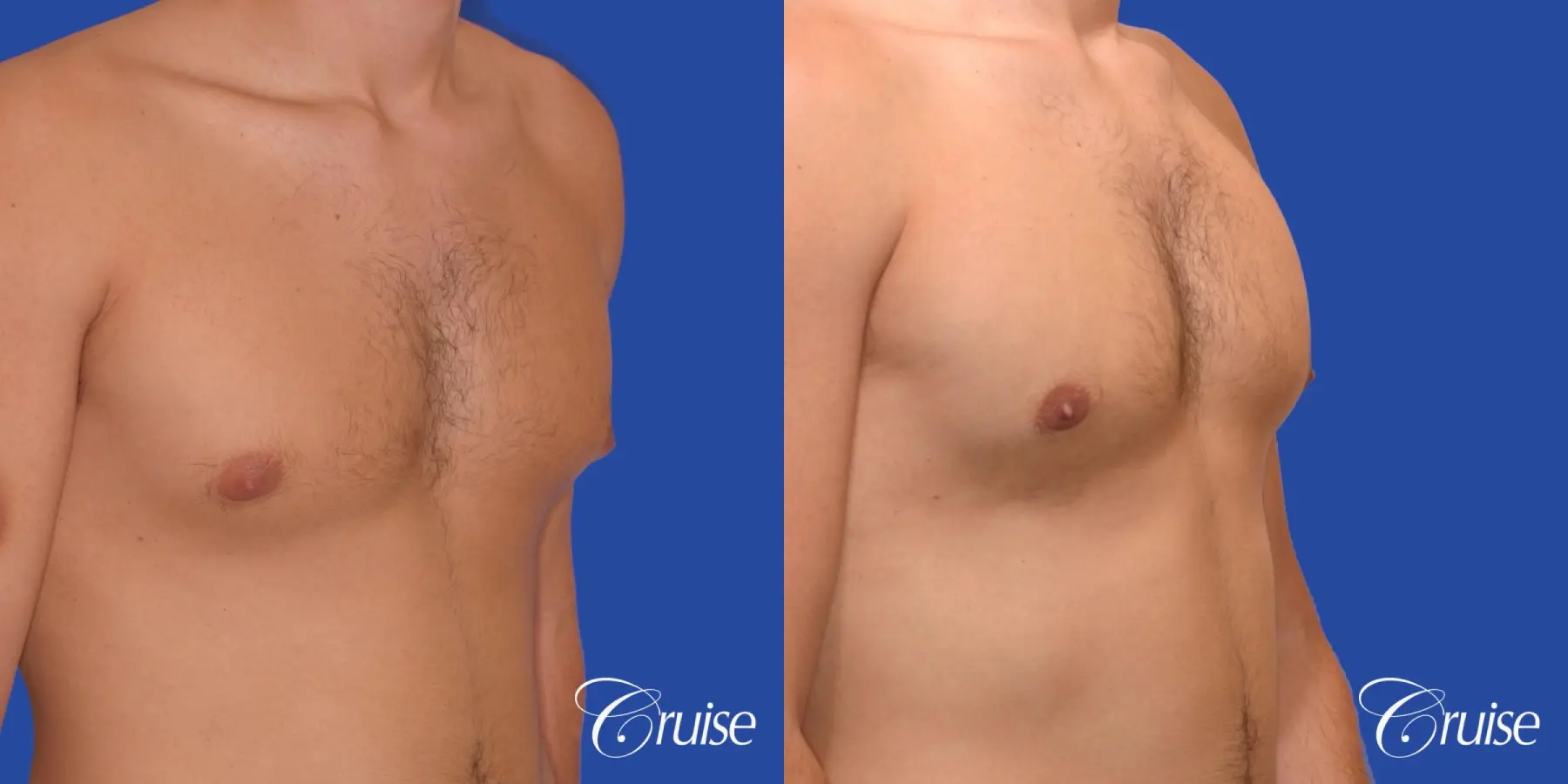 24 yr old body builder mild gynecomastia - Before and After 3