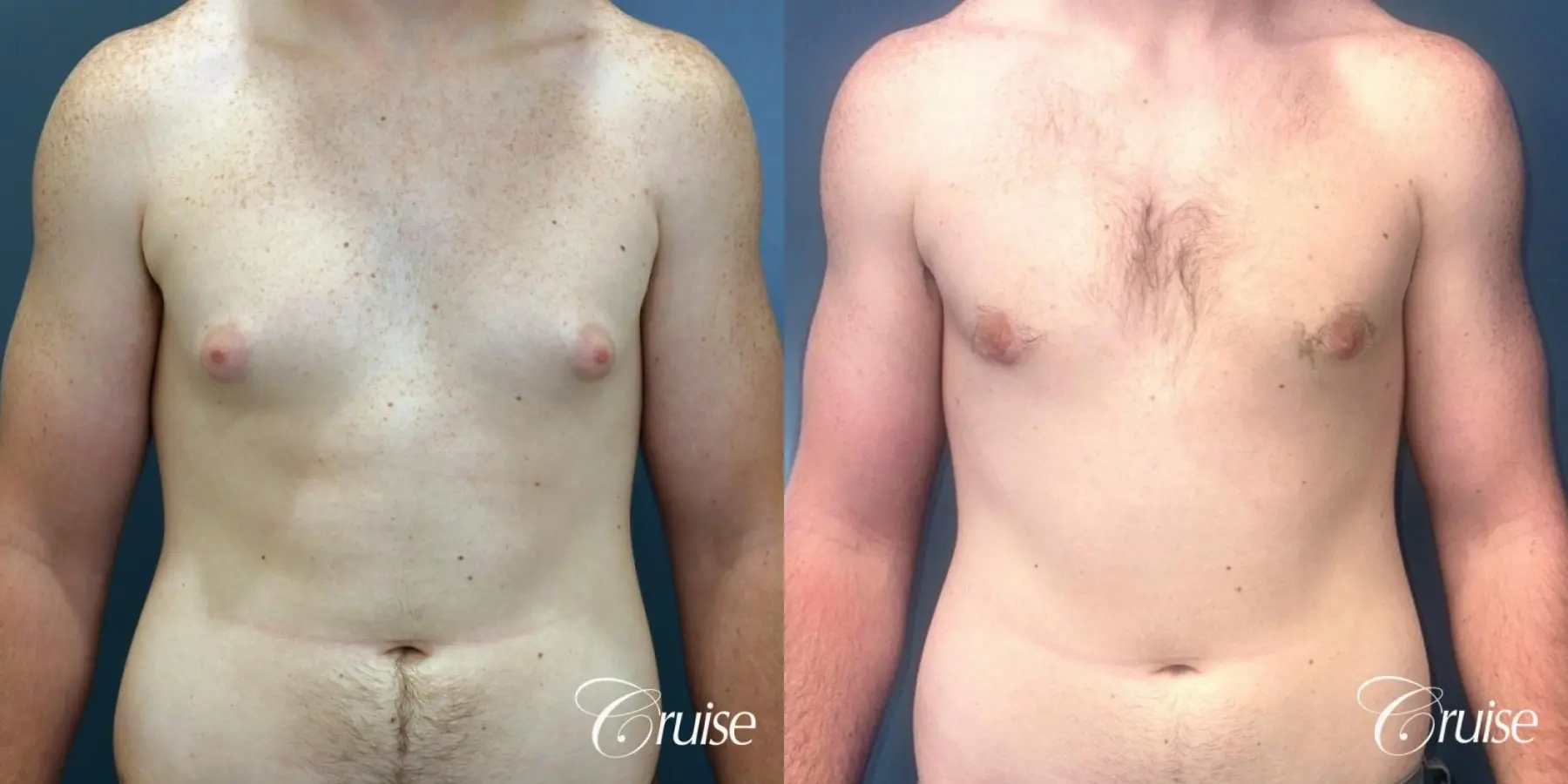 Gynecomastia: Patient 137 - Before and After 1