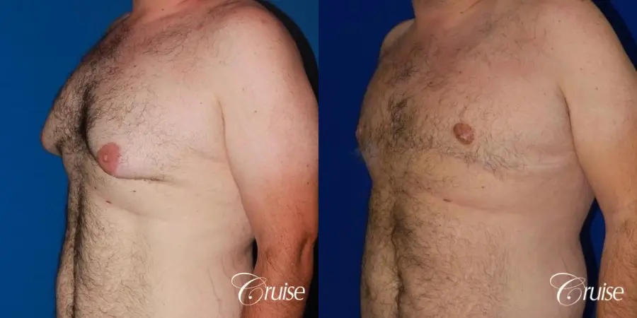 Severe Gynecomastia -Free Nipple Graft - Before and After 2