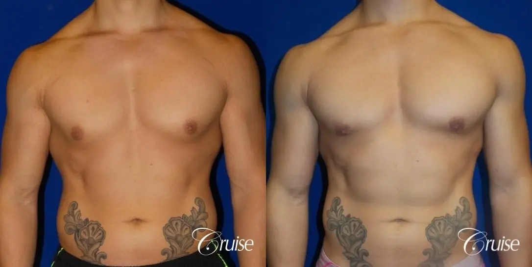 Type 3 Body Builder Gynecomastia with Puffy Nipples - Before and After 1