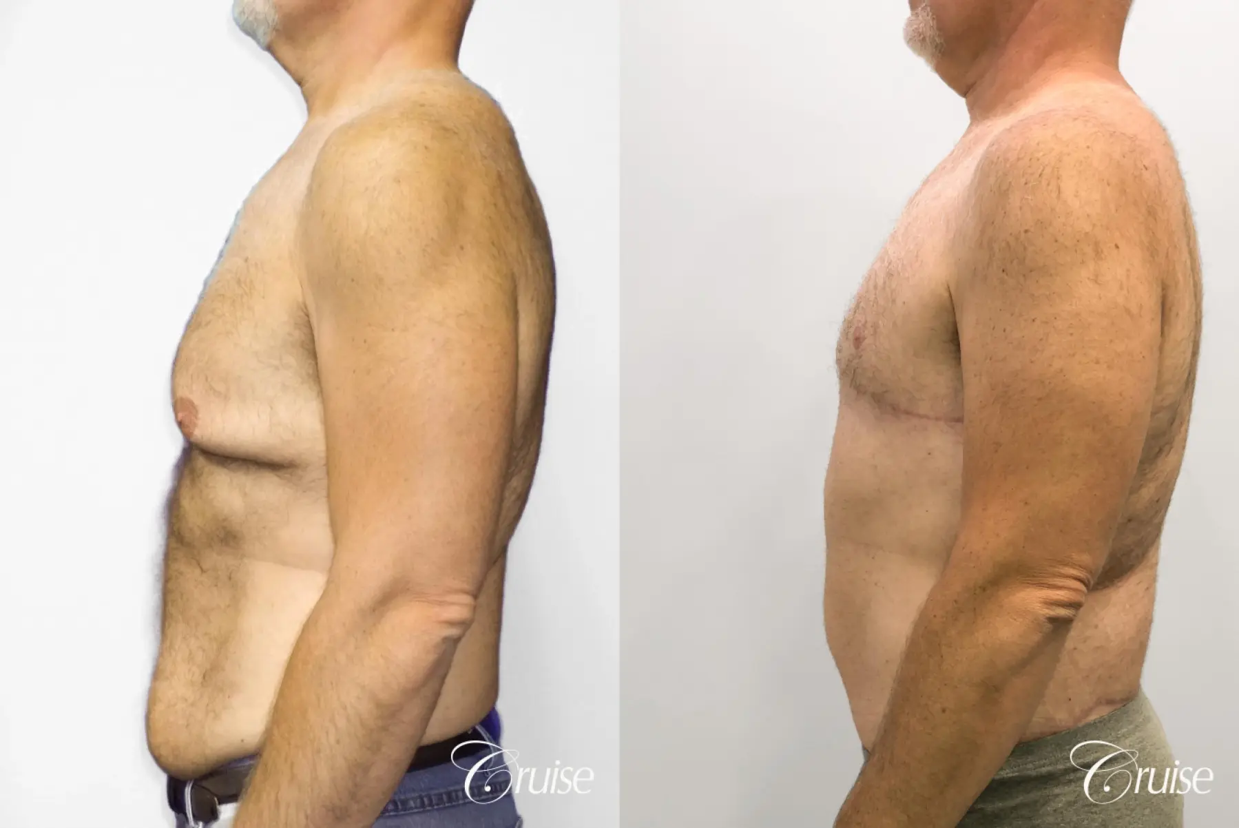 Gynecomastia: Patient 142 - Before and After 3