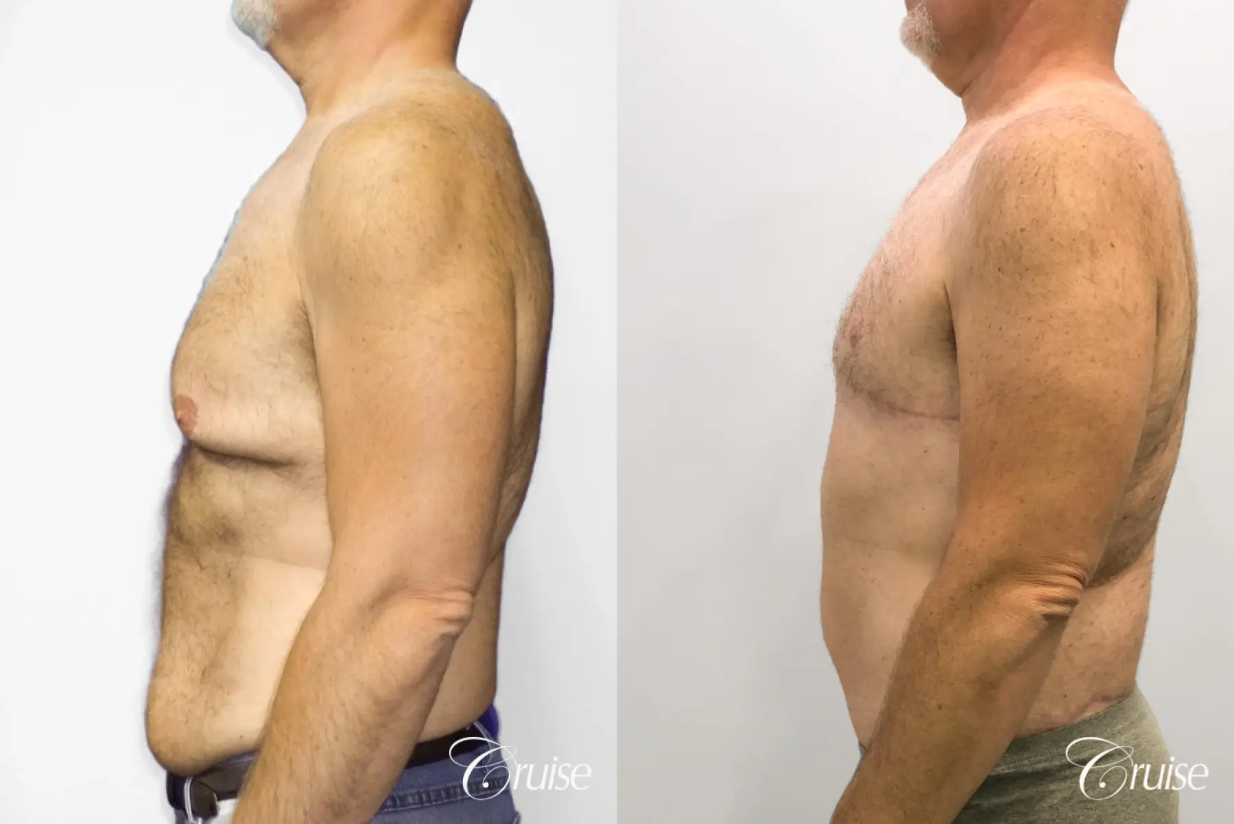 Gynecomastia: Patient 144 - Before and After 3