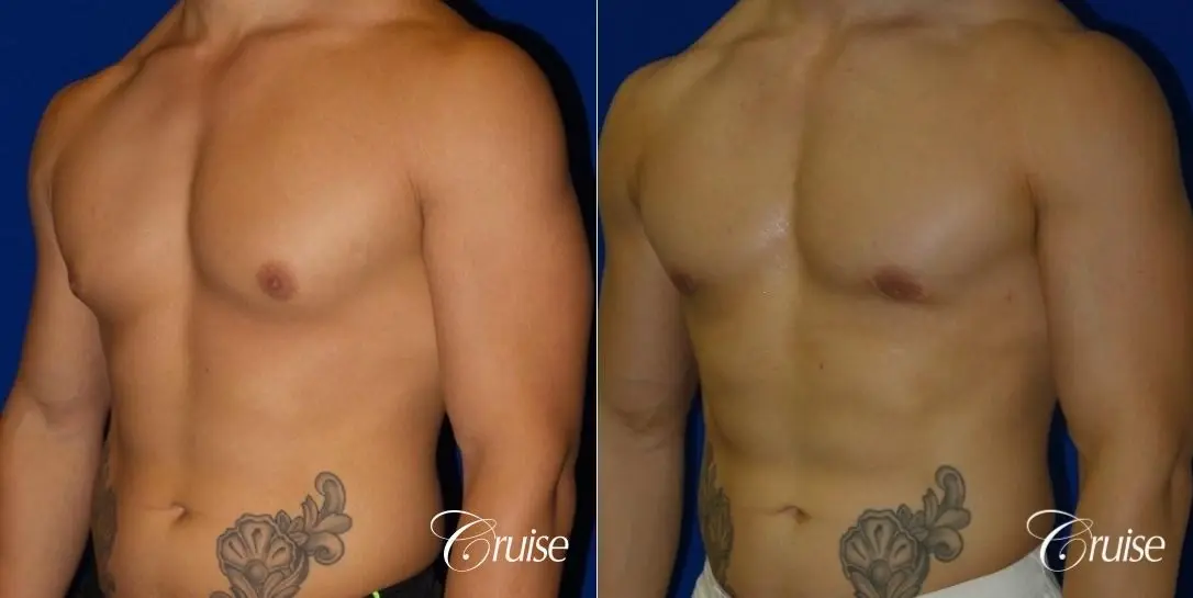 Type 3 Body Builder Gynecomastia with Puffy Nipples - Before and After 2
