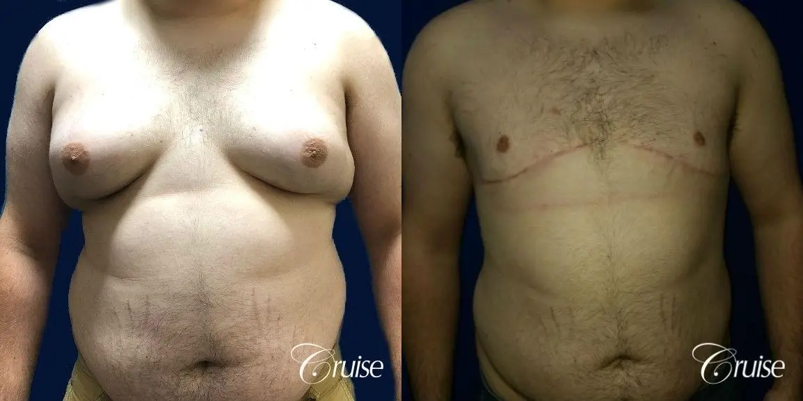 male breast reduction surgery orange county - Before and After 1