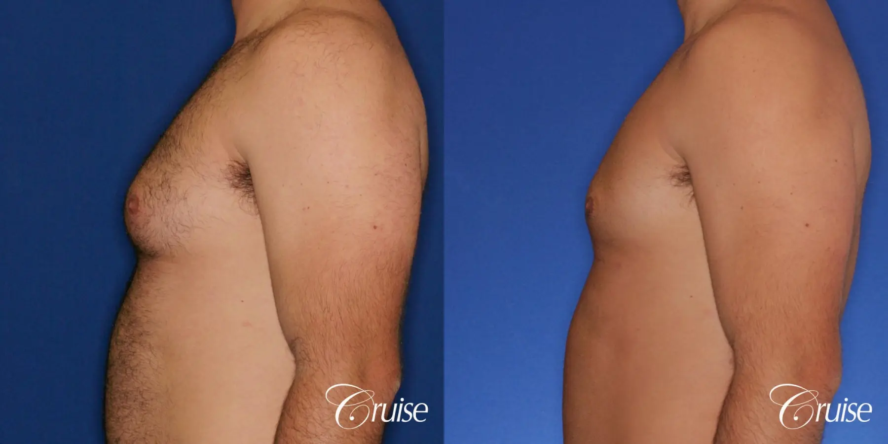 male patient has mild gynecomastia - Before and After 2