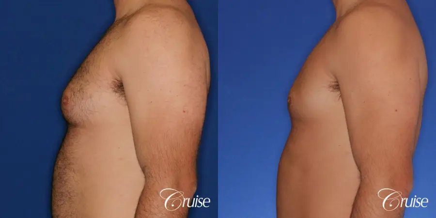 male patient has mild gynecomastia - Before and After 2