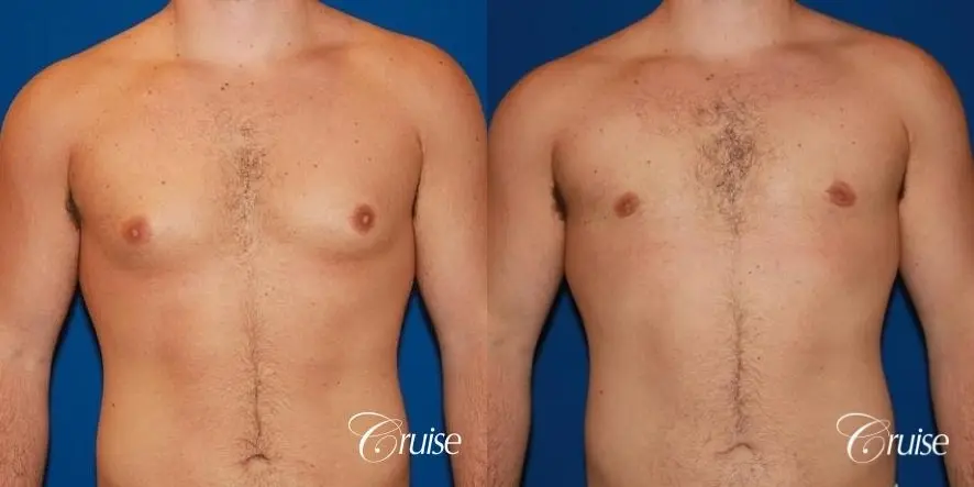 athletic adult with puffy nipple - Before and After 1
