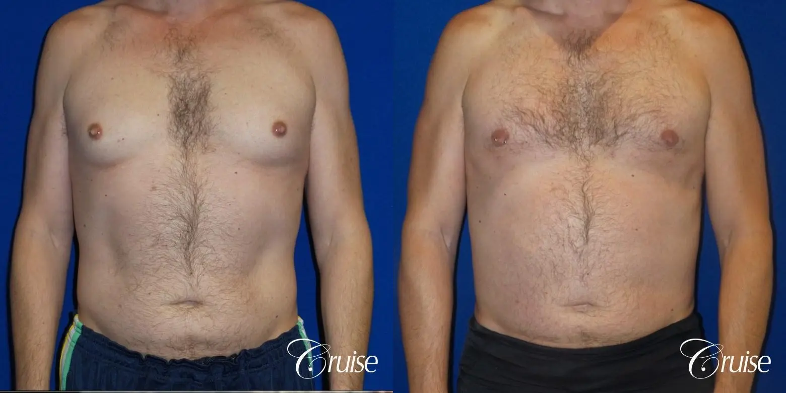 Best Gynecomastia surgeons Los Angeles - Before and After 1