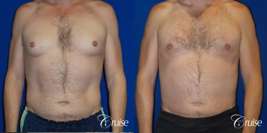 Best Gynecomastia surgeons Los Angeles - Before and After