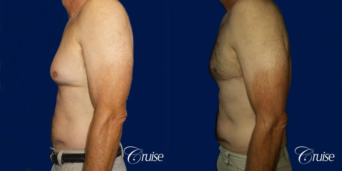 Type 4 Gynecomastia Gland Removal & Liposuction  - Before and After 2