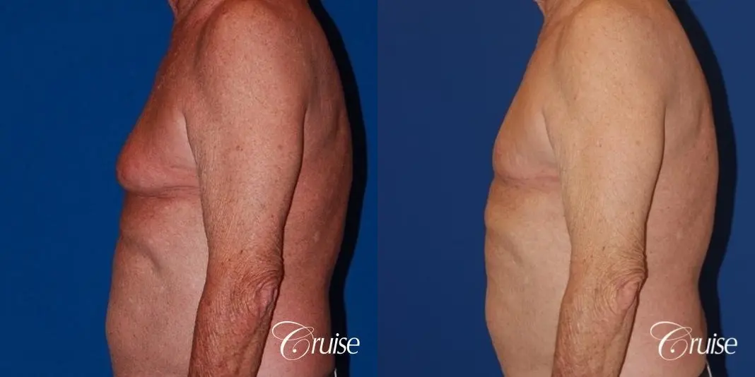 free nipple graft gynecomastia on aging man - Before and After 3