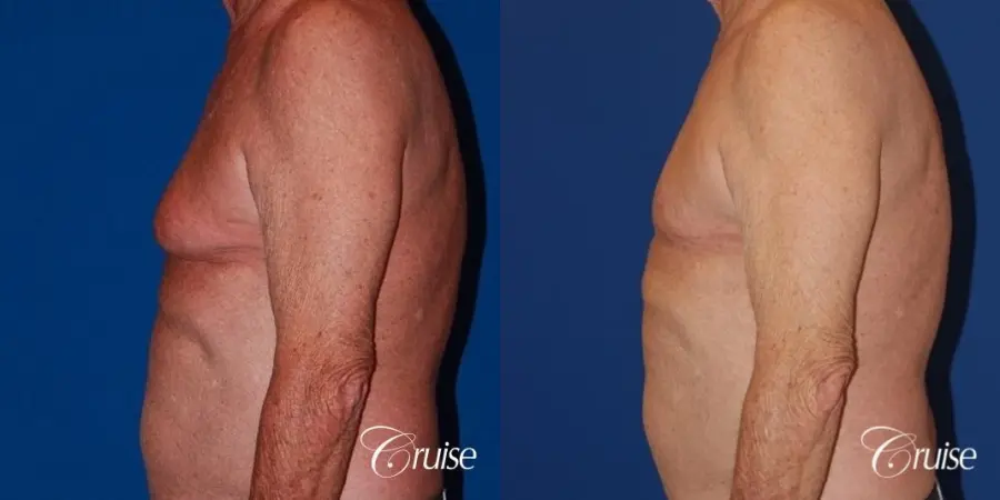 free nipple graft gynecomastia on aging man - Before and After 3