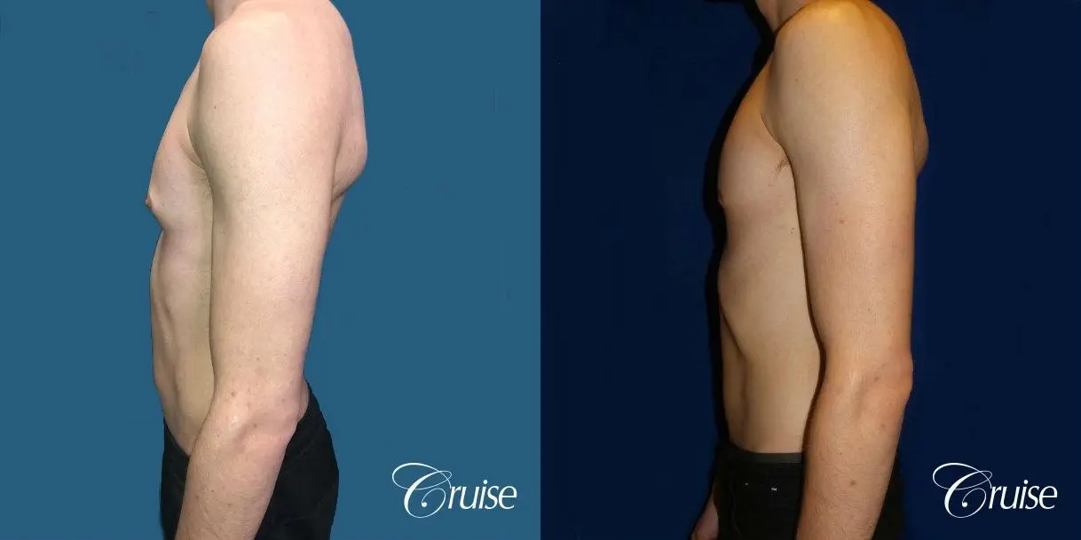 Top Gynecomastia Specialist Dr. Cruise - Before and After 2