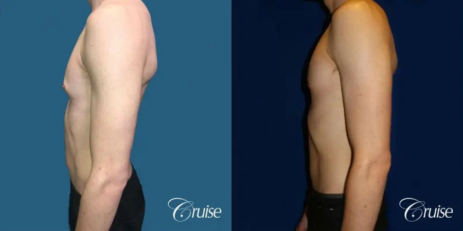 Top Gynecomastia Specialist Dr. Cruise - Before and After 2