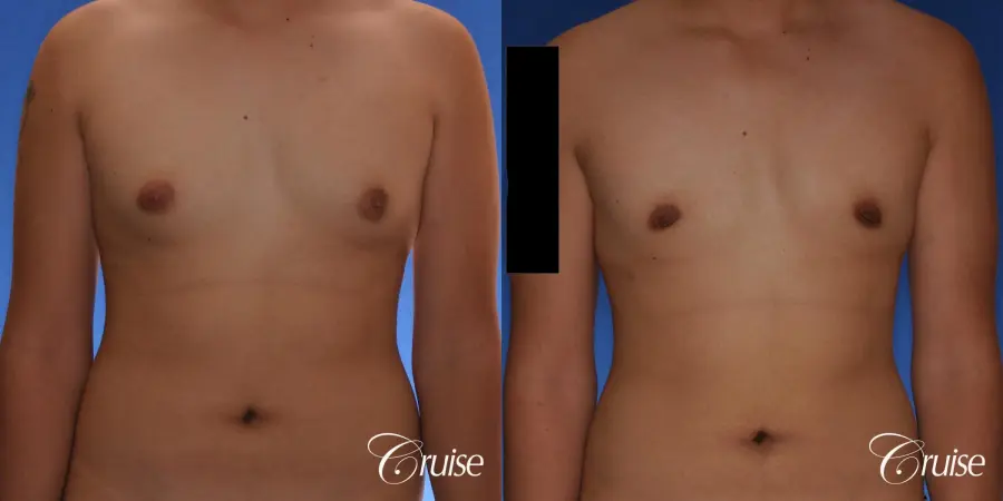 best gynecomastia surgery with plastic surgeon, Dr. Cruise - Before and After 1