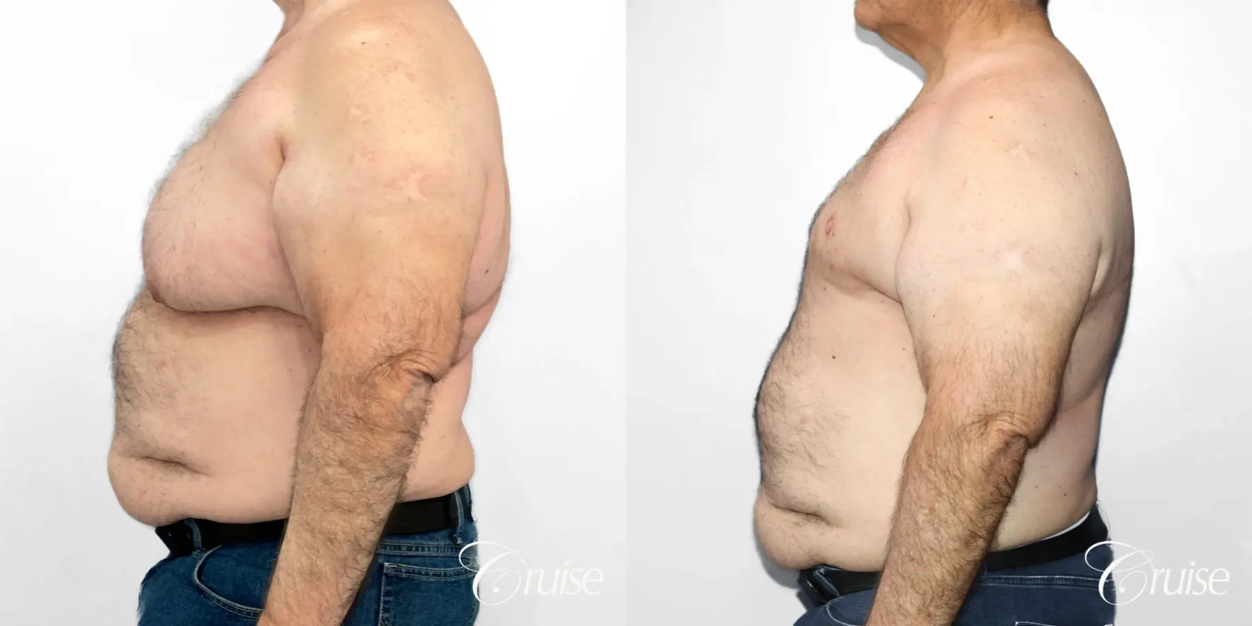 Gynecomastia: Patient 141 - Before and After 3