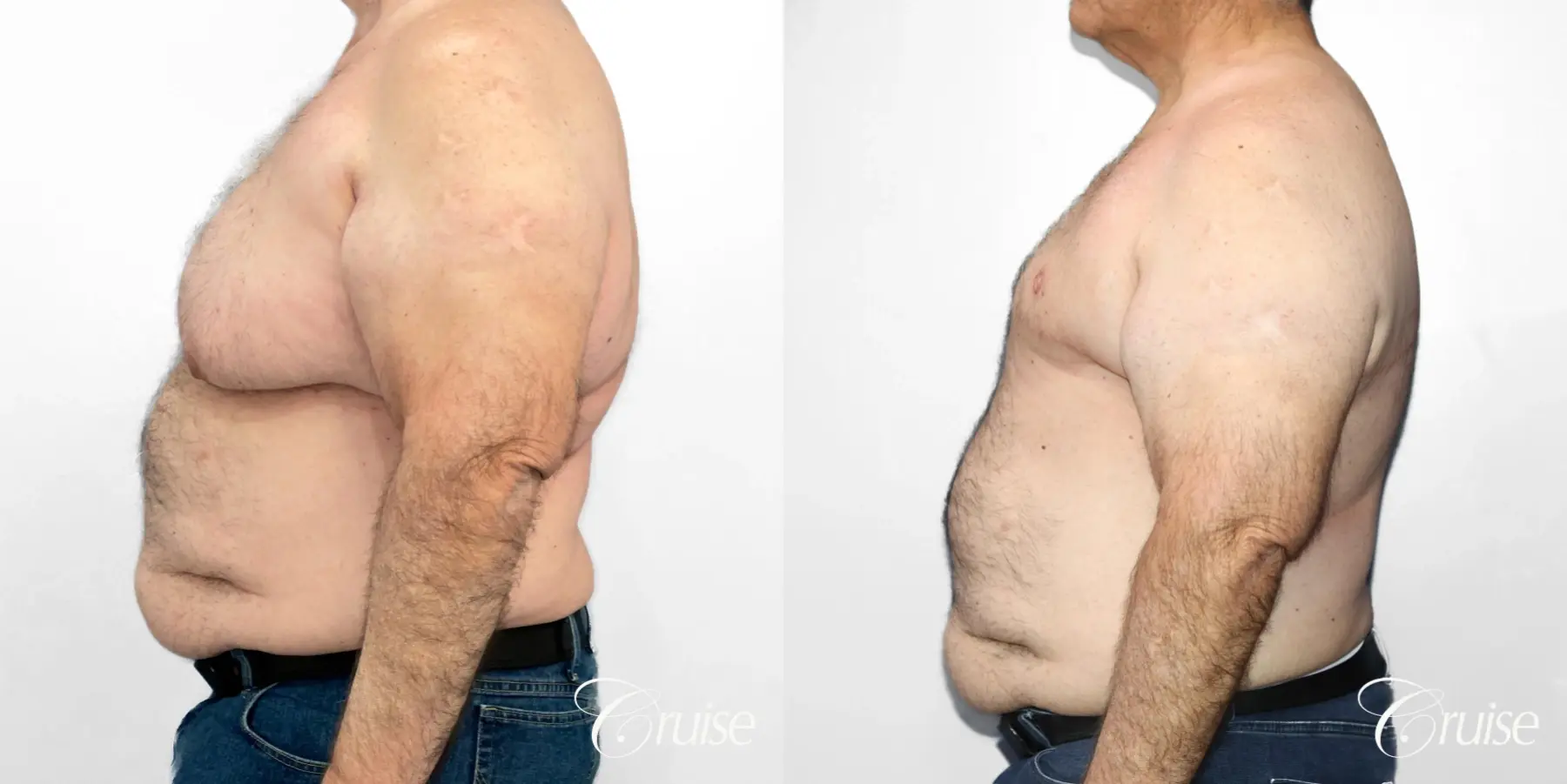 Gynecomastia: Patient 147 - Before and After 3