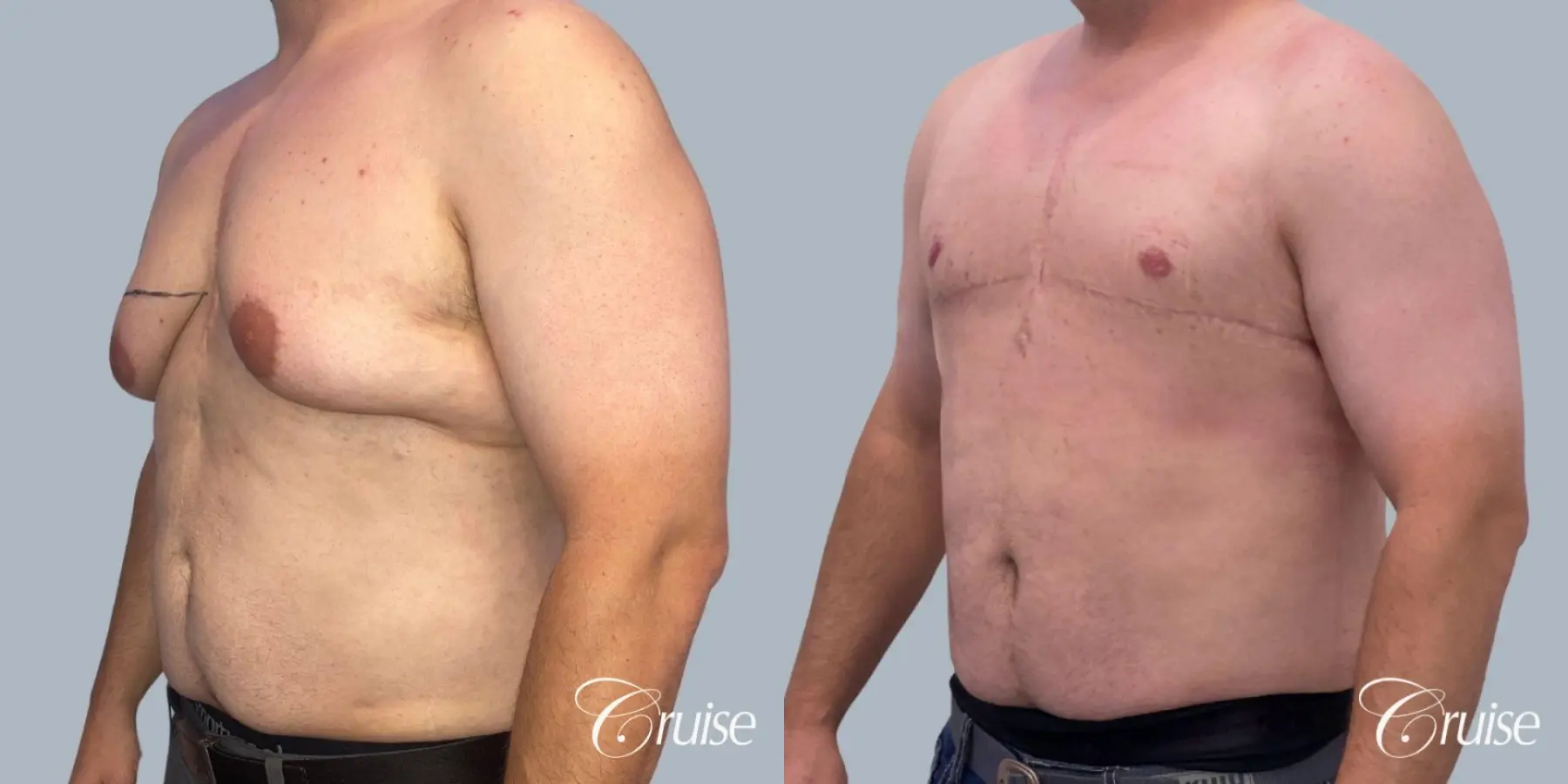 Gynecomastia: Patient 3 - Before and After 3
