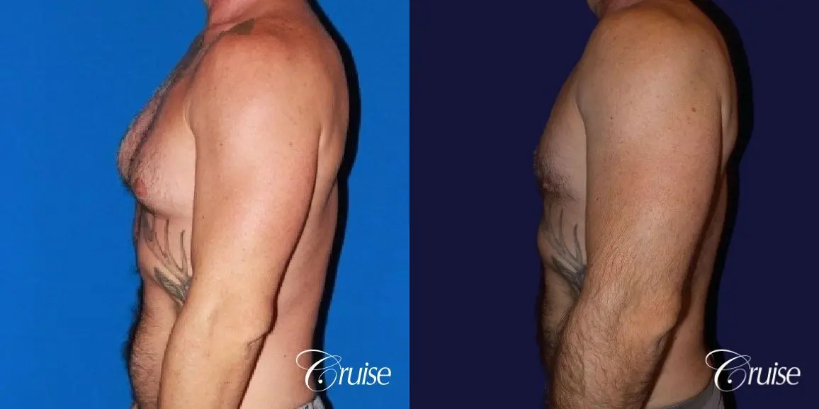 adult gynecomastia - Before and After 5
