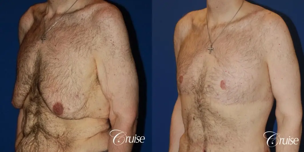 severe weight loss gynecomastia upper body lift - Before and After 2
