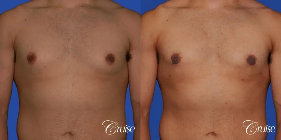 minor gyne young adult with best scars - Before and After 1