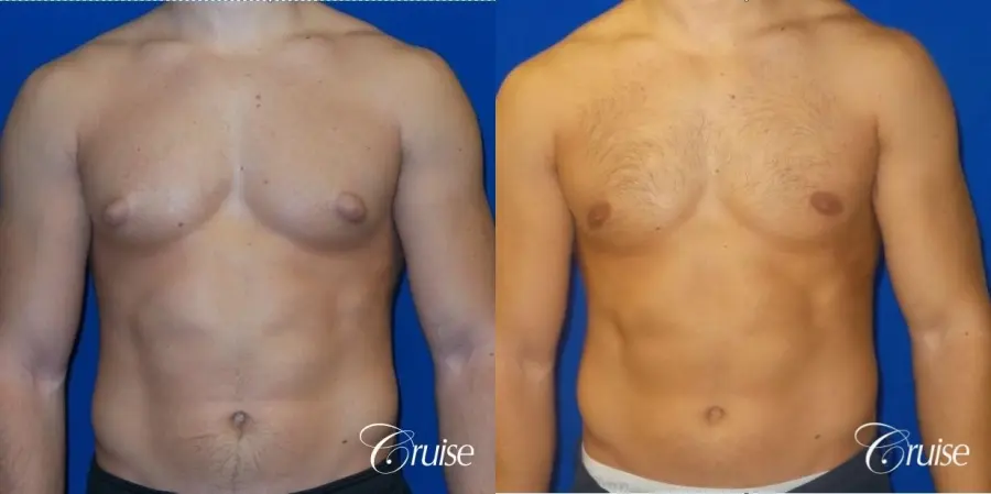 male breast reduction surgery newport beach - Before and After 1