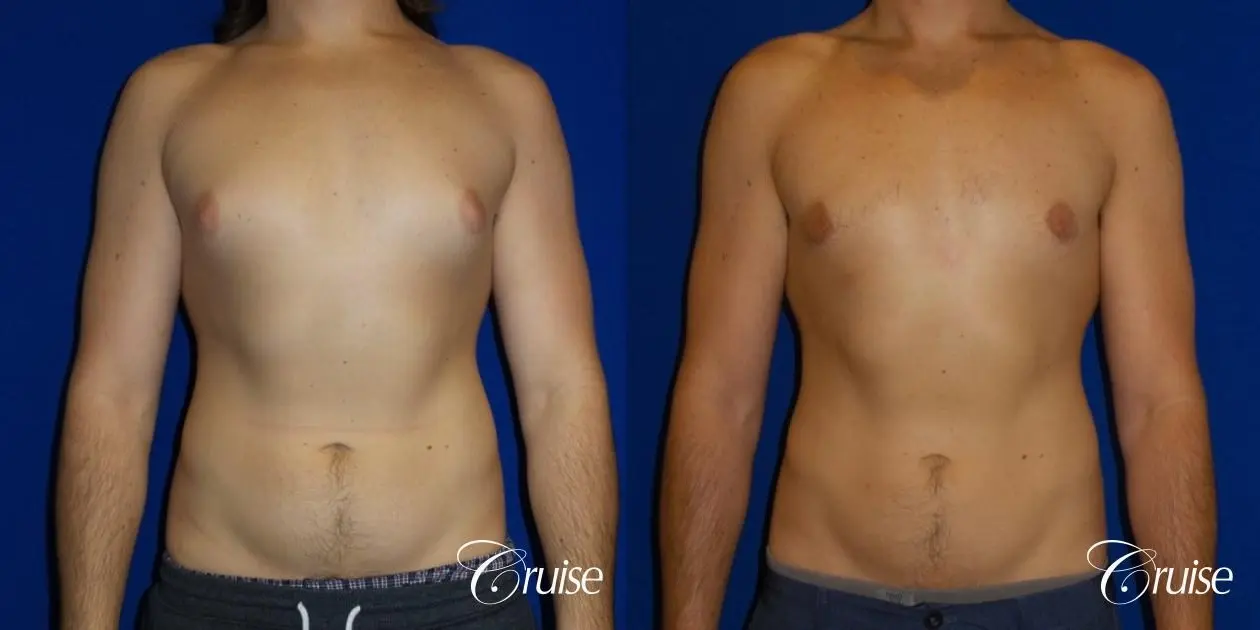 Type 2 Gynecomastia Glandular Removal  - Before and After 1