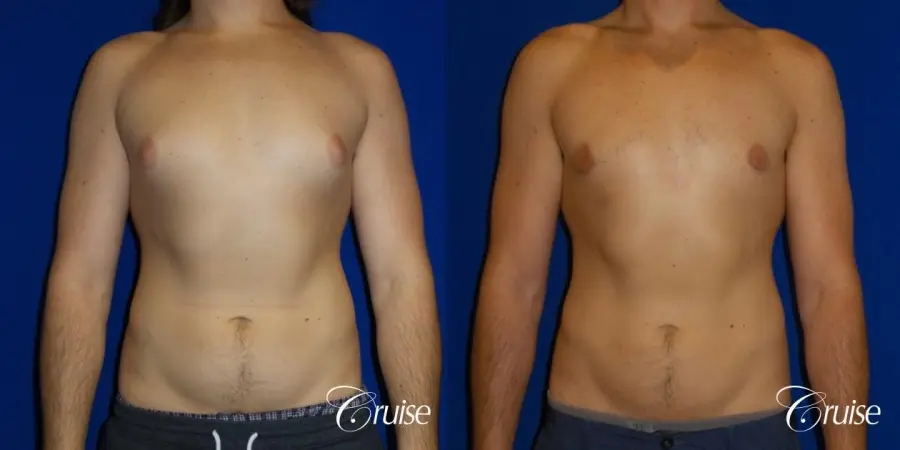 Type 2 Gynecomastia Glandular Removal - Before and After 1
