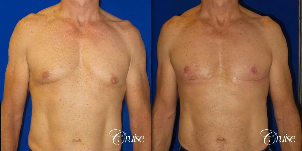 Top Gynecomastia surgeon Newport Beach - Before and After 1