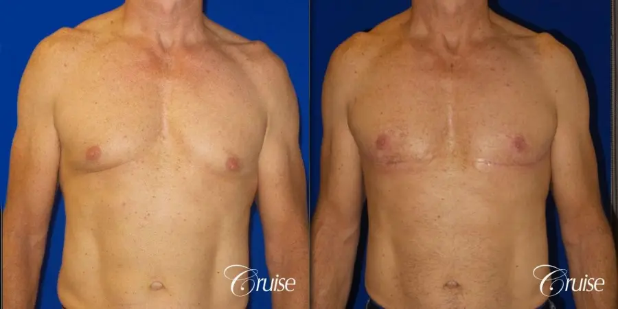 Top Gynecomastia surgeon Newport Beach - Before and After