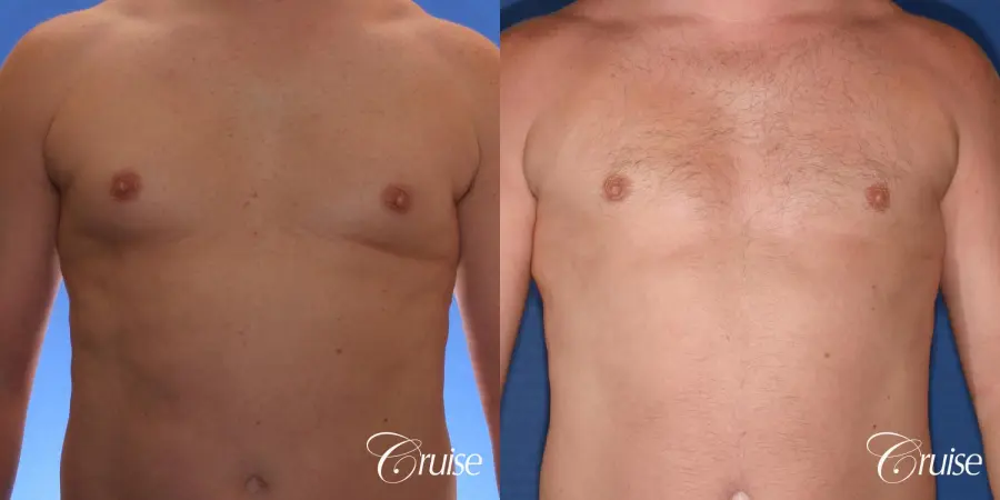 male adult with gynecomastia - Before and After 1