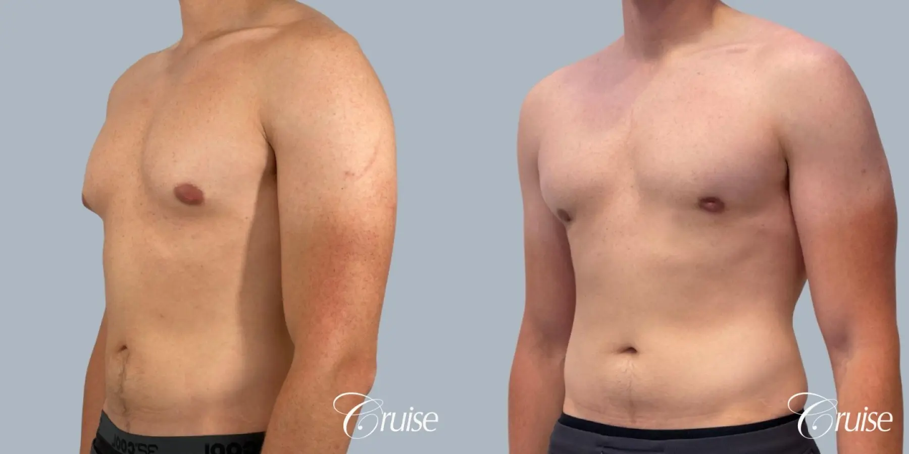 Gynecomastia: Patient 155 - Before and After 2