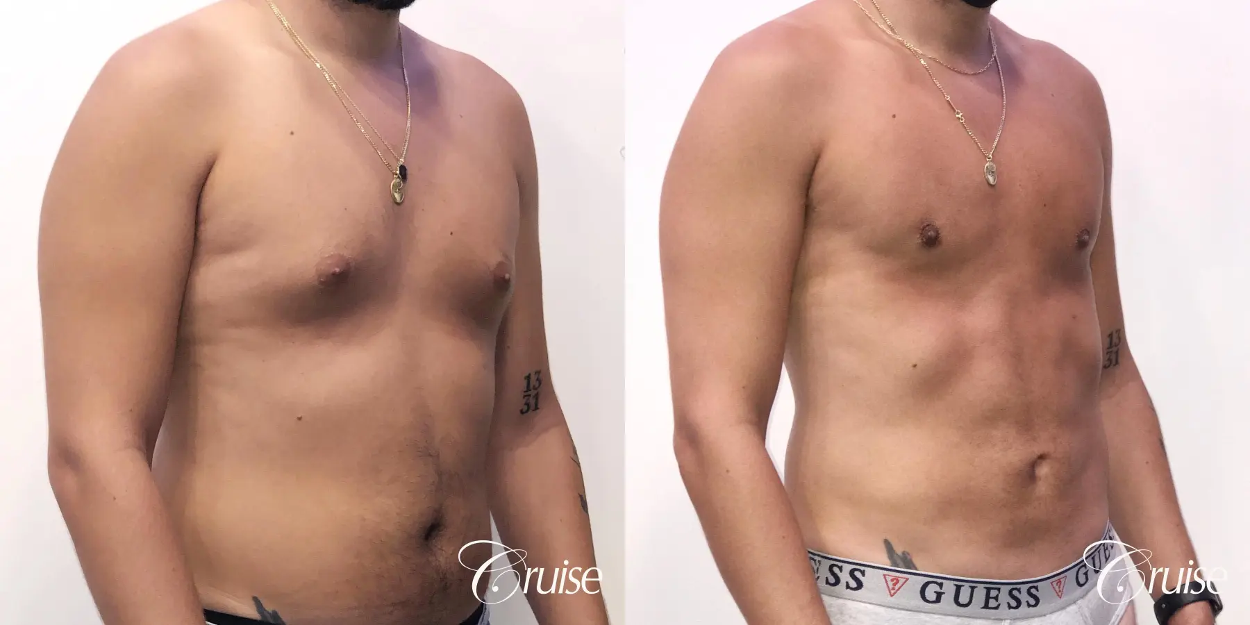 gynecomastia correction orange county - Before and After 5