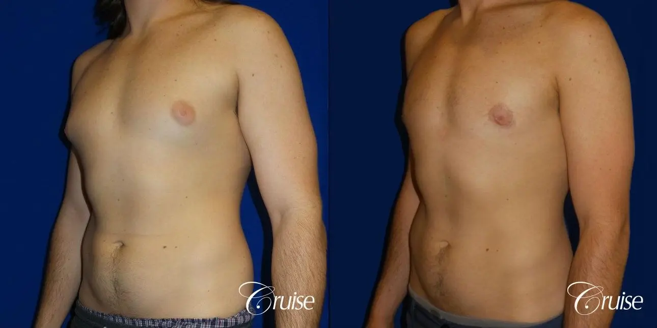 Type 2 Gynecomastia Glandular Removal  - Before and After 2