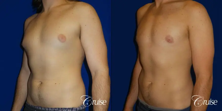 Type 2 Gynecomastia Glandular Removal - Before and After 2