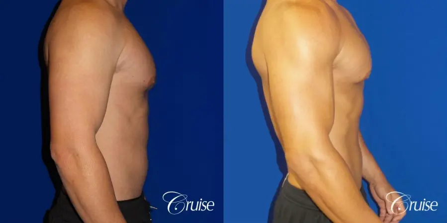 Gynecomastia puffy nipples cost - Before and After 3