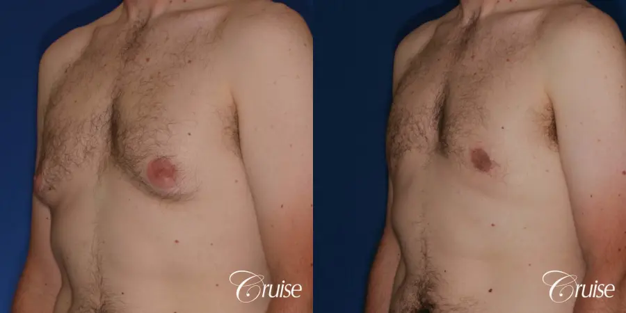 gynecomastia with skin laxity - Before and After 3