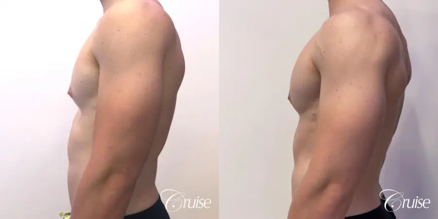 gynecomastia with puffy nipples - Before and After 2