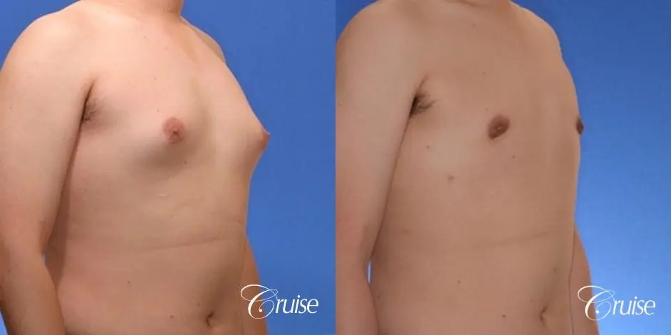 young male with mild gynecomastia surgery for puffy nipple - Before and After 4