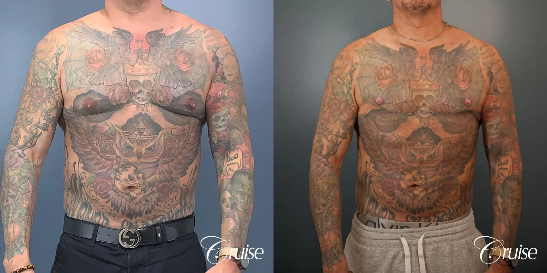 Gynecomastia: Patient 136 - Before and After 1