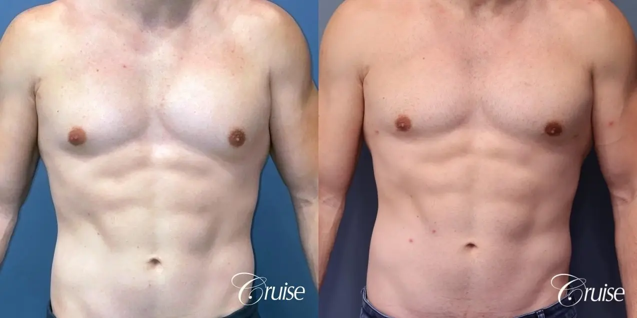 Gynecomastia: Patient 146 - Before and After 1