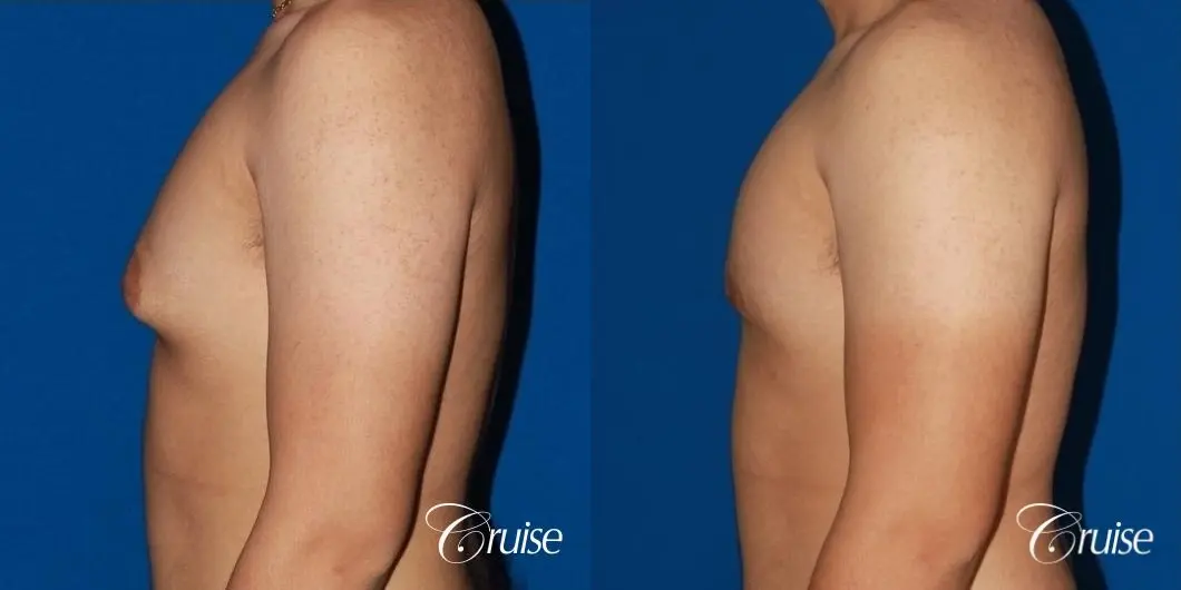 puffy nipple male breast on young adult - Before and After 2