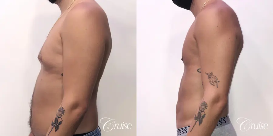 gynecomastia correction orange county - Before and After 2