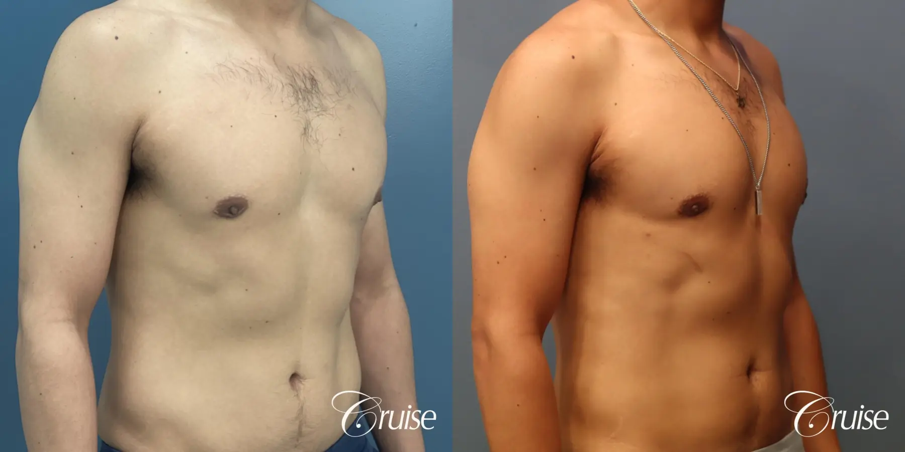 Gynecomastia: Patient 139 - Before and After 2