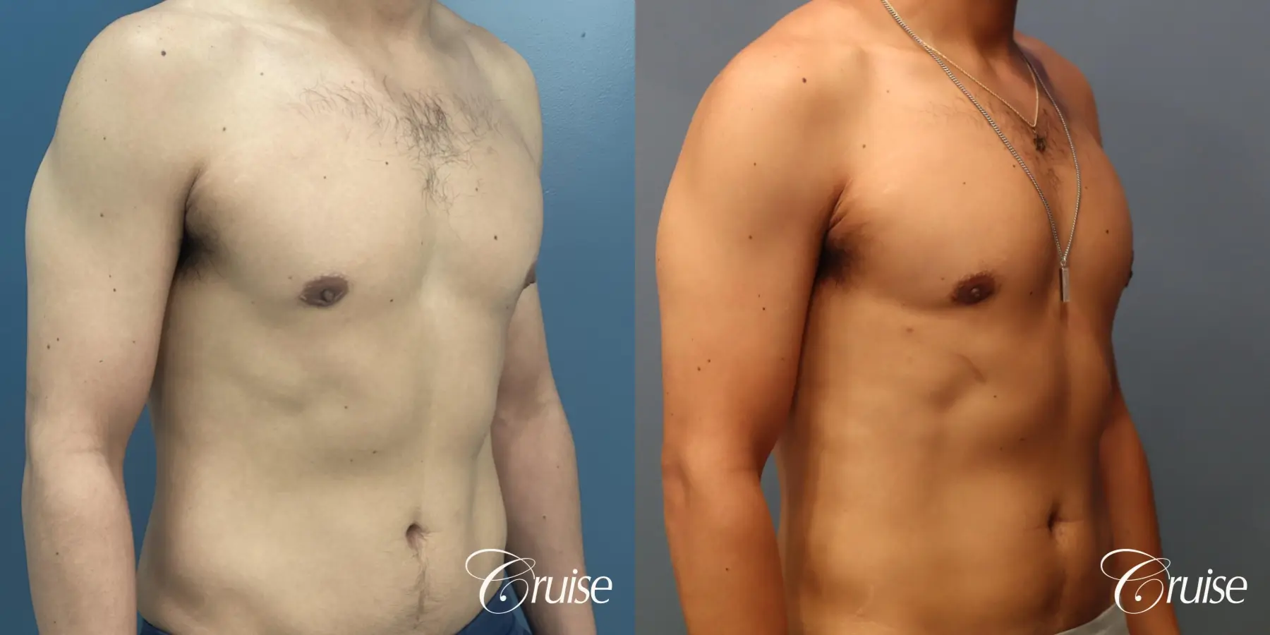 Gynecomastia: Patient 141 - Before and After 2