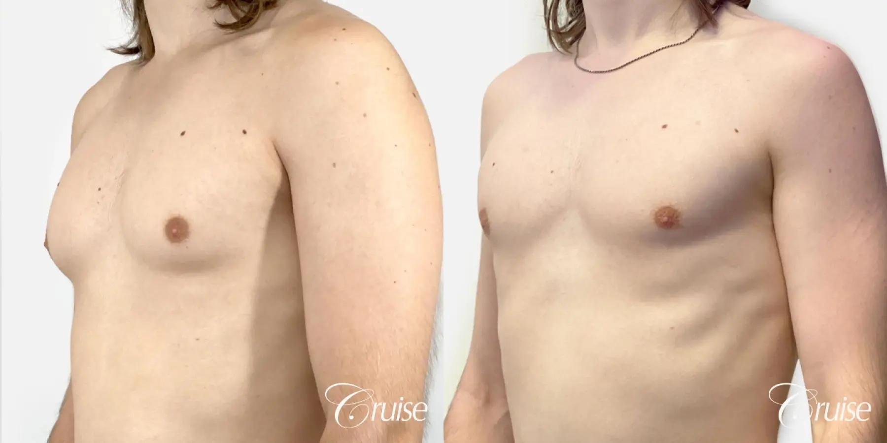 Type 1 Gynecomastia Removal - Before and After 2