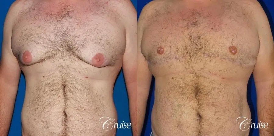 Severe Gynecomastia -Free Nipple Graft - Before and After 1