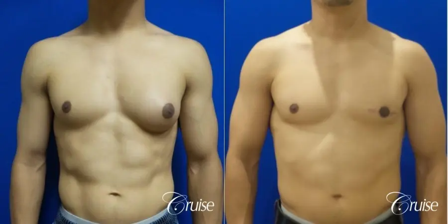 Unilateral gynecomastia before and after - Before and After 1