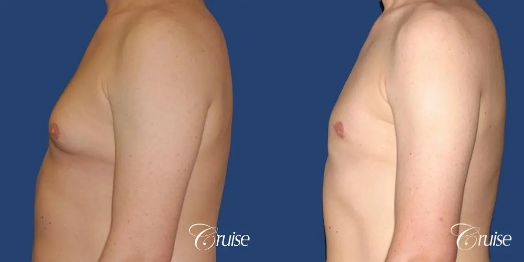 moderate gynecomastia on adult donut lift - Before and After 2