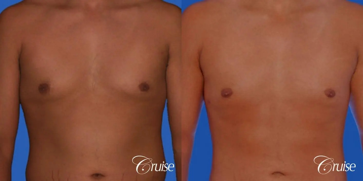 26yr old with mild gynecomastia - Before and After 1